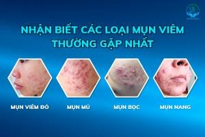 Ổ mụn viêm là một tình trạng da phổ biến, được xác định bởi một vùng da đỏ, sưng và mủ. Nó thường xảy ra khi tuyến bã nhờn bị tắc và bị nhiễm khuẩn bởi vi khuẩn, gây ra sự viêm và mụn.