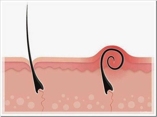 Lỗ chân lông bị tắc nghẽn do tế bào chết là một tình trạng rất phổ biến trên da, gây ra mụn đầu đen và mụn đầu trắng, làm cho da mất đi sự mịn màng và sáng bóng.