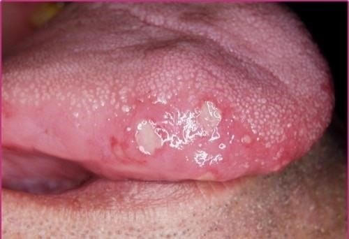 Herpes miệng gây ra các vết loét thường xuất hiện dưới dạng nhóm.