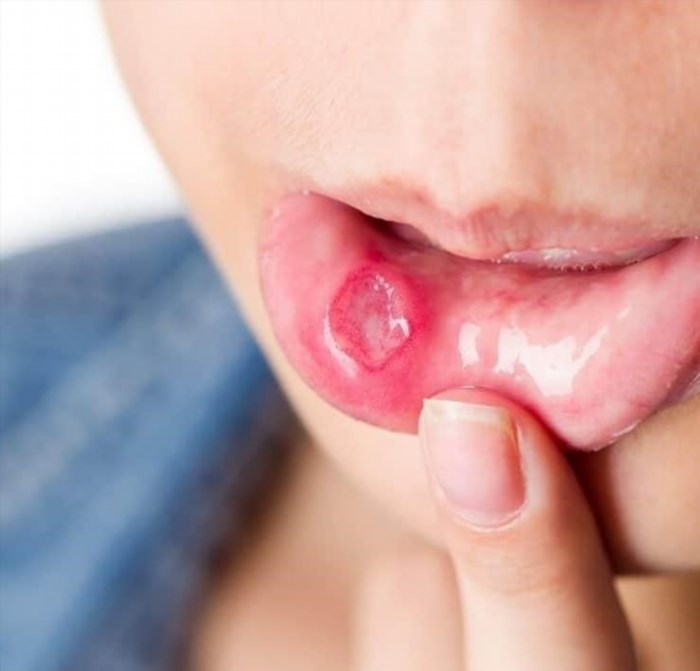 Các vết loét xảy ra xung quanh miệng khi mắc bệnh nhiệt miệng.