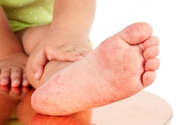 Chẩn đoán nổi mụn nước ở bàn chân được xác định dựa trên triệu chứng như da đỏ, ngứa, và mụn nước xuất hiện. Đây là tình trạng phổ biến và thường không đe dọa đến sức khỏe, tuy nhiên nếu triệu chứng kéo dài hoặc xuất hiện các dấu hiệu nghiêm trọng hơn như sưng, đau hoặc nhiễm trùng, bạn nên tìm kiếm sự giúp đỡ y tế để điều trị.