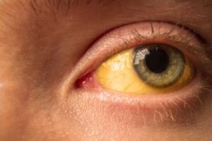 Cách chữa lòng trắng mắt bị vàng