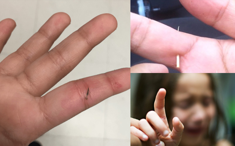 cách lấy dằm đâm vào tay