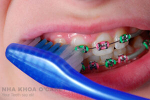 Cách vệ sinh răng miệng sau khi niềng răng
